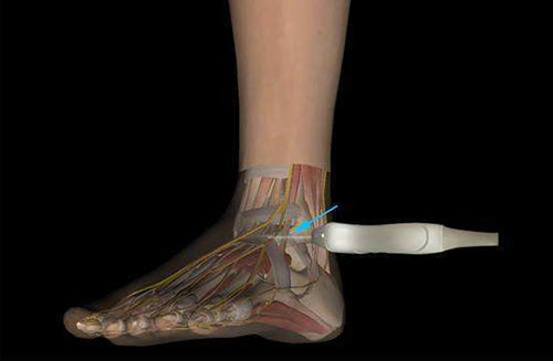 肌骨超聲：適用于骨科肌骨檢查新方式